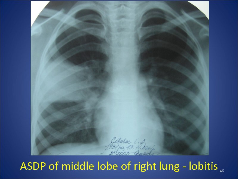 ASDP of middle lobe of right lung - lobitis  46